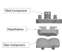 Exactech Recall Ankle Device